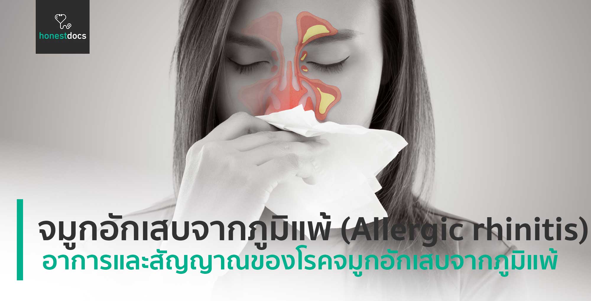 allergic rhinitis รักษา ต่อยอด