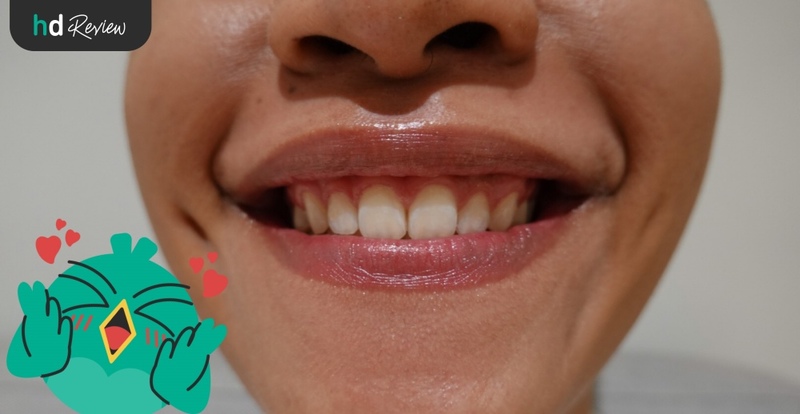 ผลลัพธ์ 1 สัปดาห์หลังฟอกสีฟันที่ Let's Smile Dental Clinic